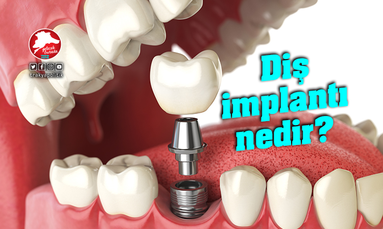 Diş implantı nedir?
